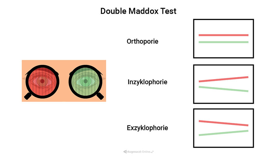Double Maddox Rod Test Atlas der Augenheilkunde